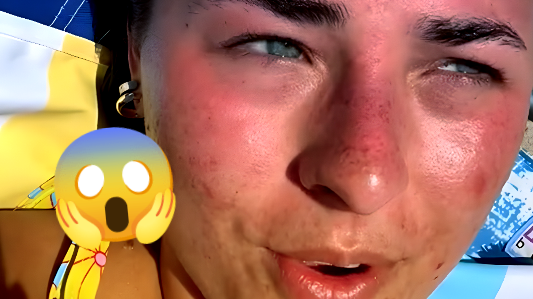 Tendenza TikTok pericolosa: "L'abbronzatura può guarire l'acne?" Gli influencer ne sono convinti, ma i dottori avvertono: "Non provatelo!"